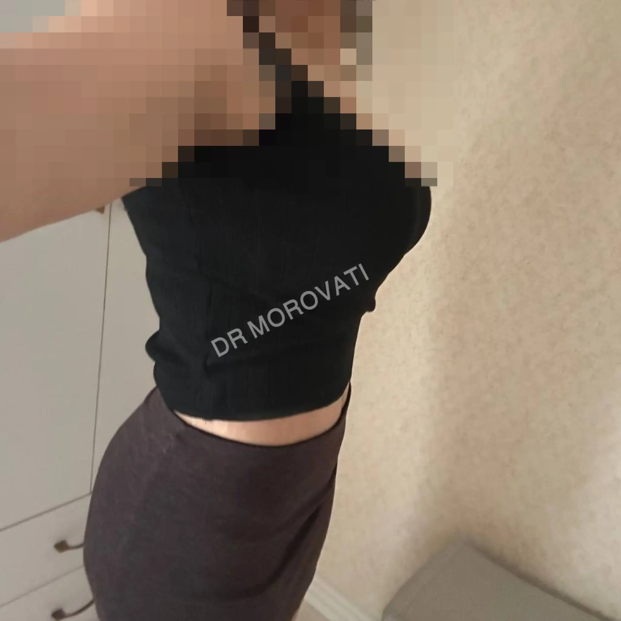 تصویر نمونه قبل و بعد ابدومینوپلاستی و فرم‌دهی طبیعی شکم