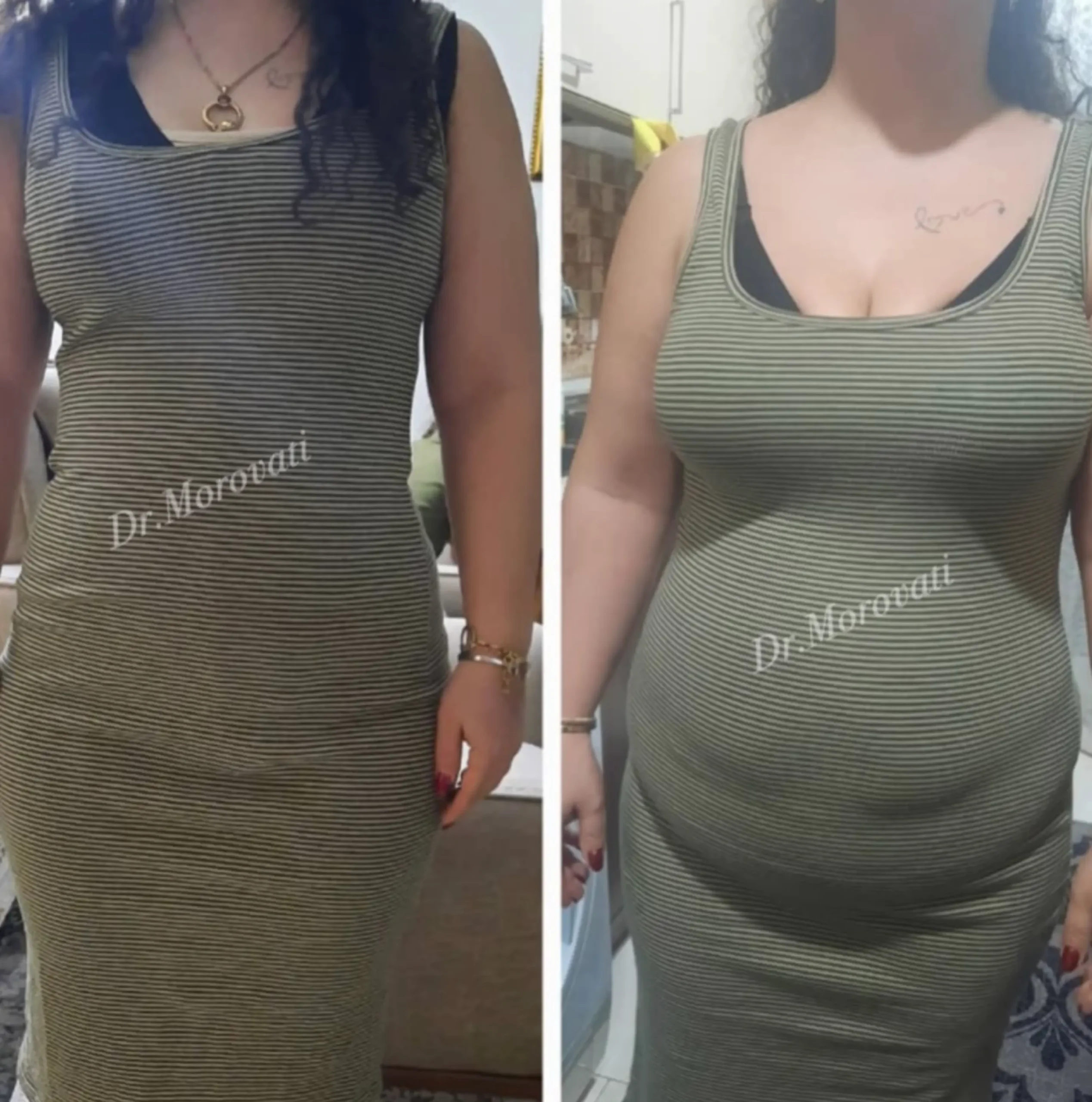 گالری نمونه کارهای ابدومینوپلاستی دکتر مروتی