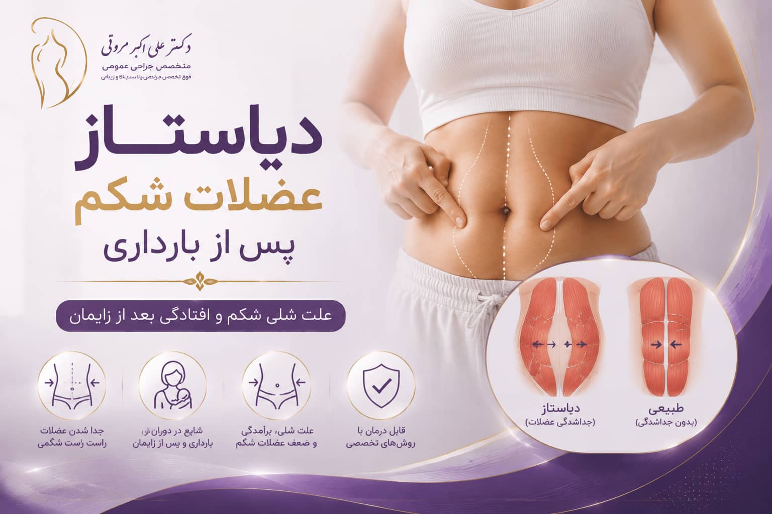 دیاستاز عضلات شکم پس از بارداری