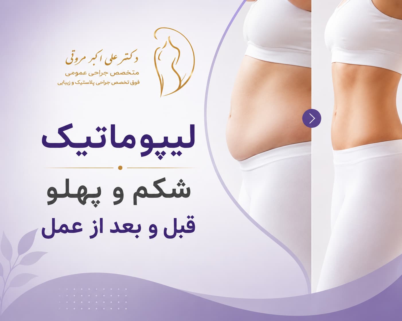 لیپوماتیک شکم و پهلو قبل و بعد از عمل