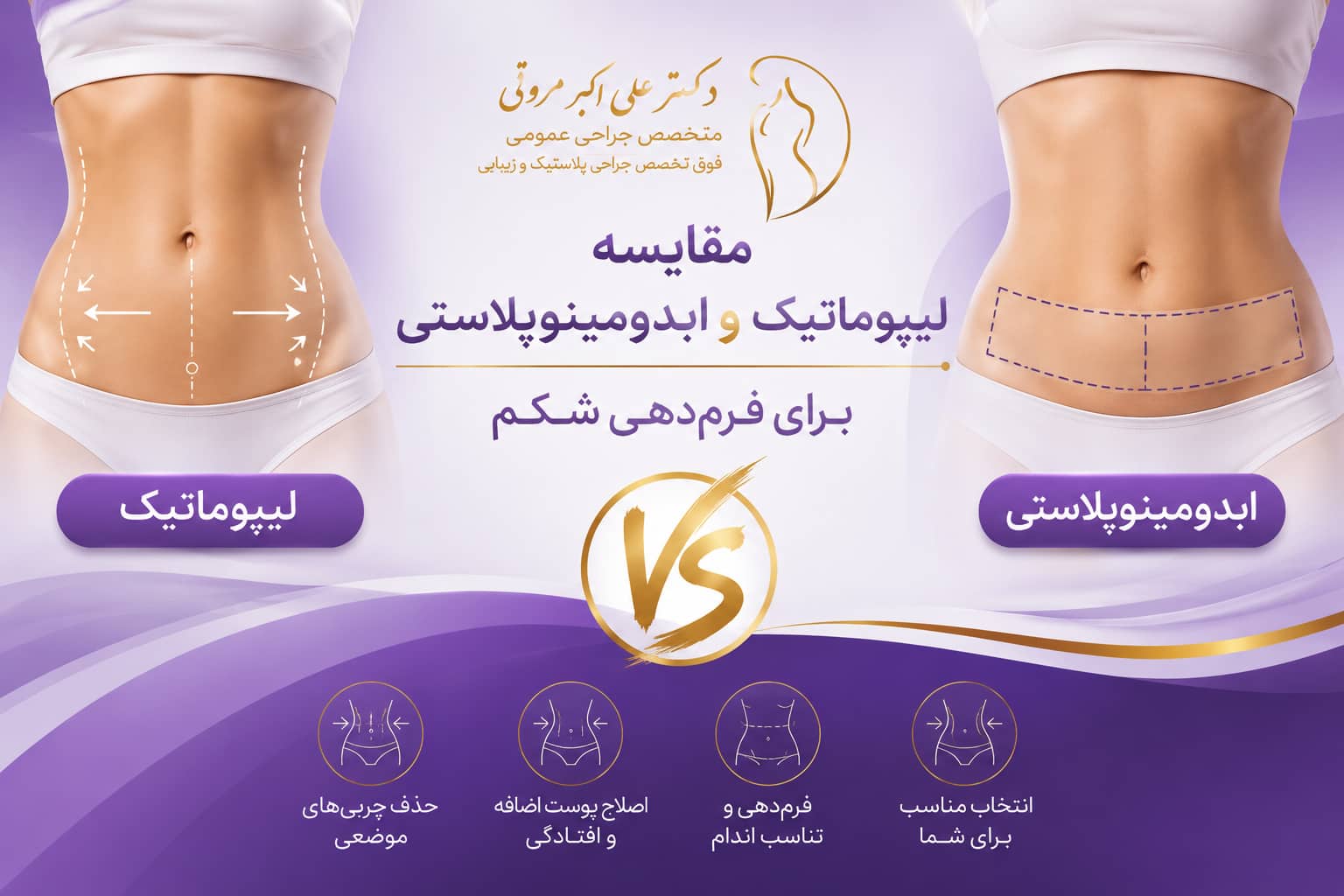 مقایسه لیپوماتیک و ابدومینوپلاستی برای فرم_دهی شکم