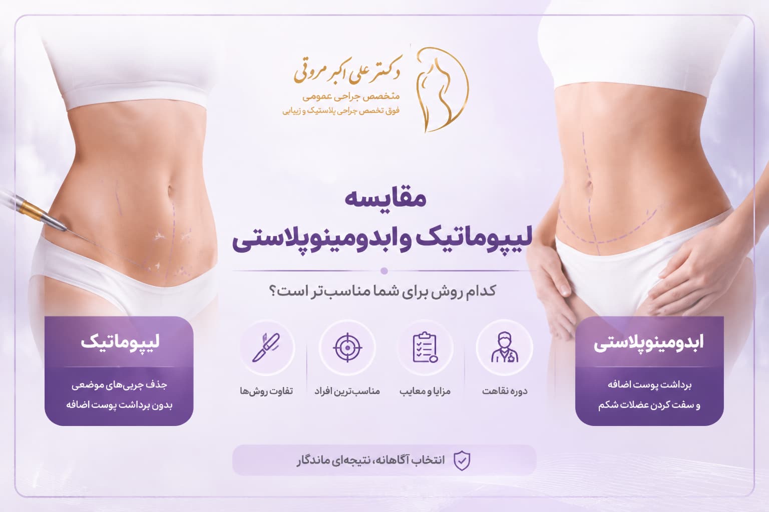 مقایسه لیپوماتیک و ابدومینوپلاستی