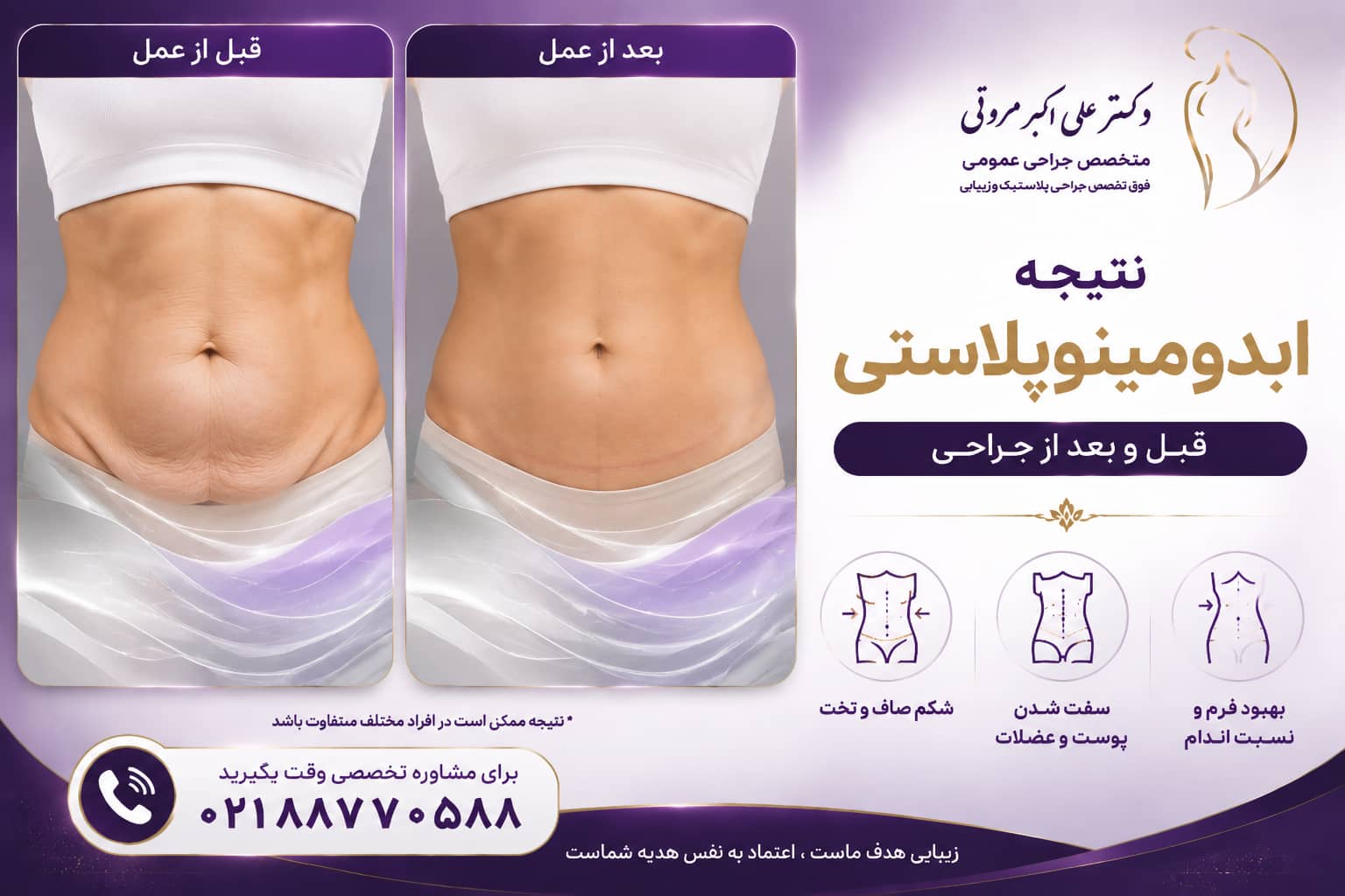 نتیجه ابدومینوپلاستی قبل و بعد
