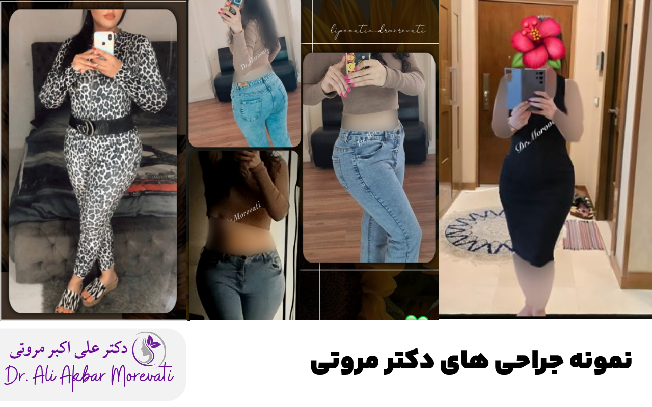 نمونه جراحی لیپوماتیک دکتر مروتی
