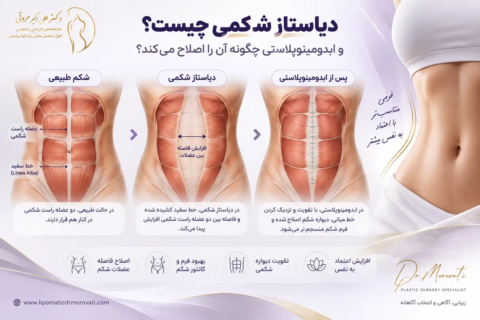 اصلاح دیاستاز شکمی در ابدومینوپلاستی