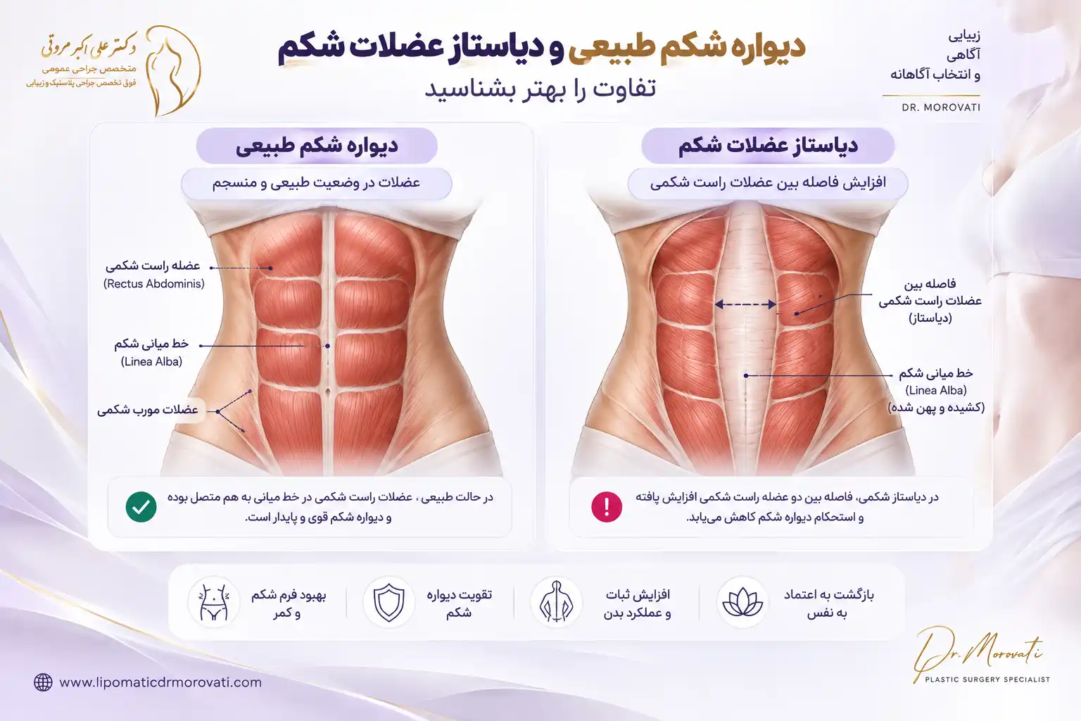 تفاوت شکم طبیعی با دیاستاز عضلات شکم