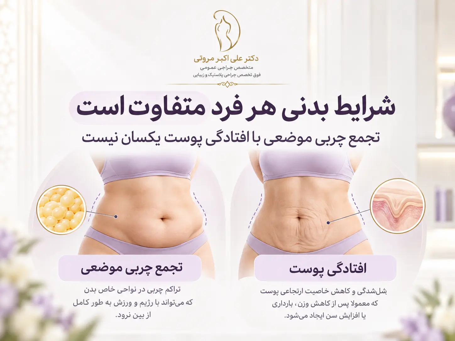 تفاوت کاربرد لیپوماتیک و ابدومینوپلاستی در فرم_دهی شکم و اصلاح افتادگی پوست